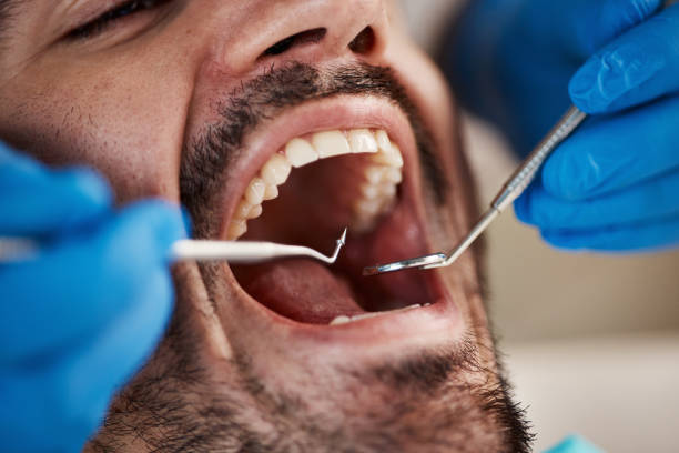Best Broken or Chipped Tooth Repair in Woods Creek, WA