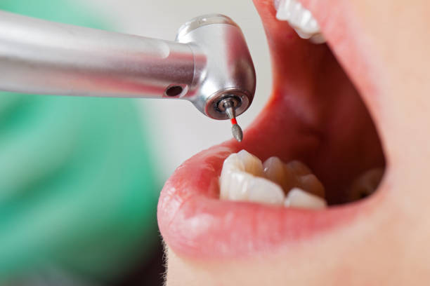 Best Knocked-Out Tooth (Avulsed Tooth) Treatment in Woods Creek, WA
